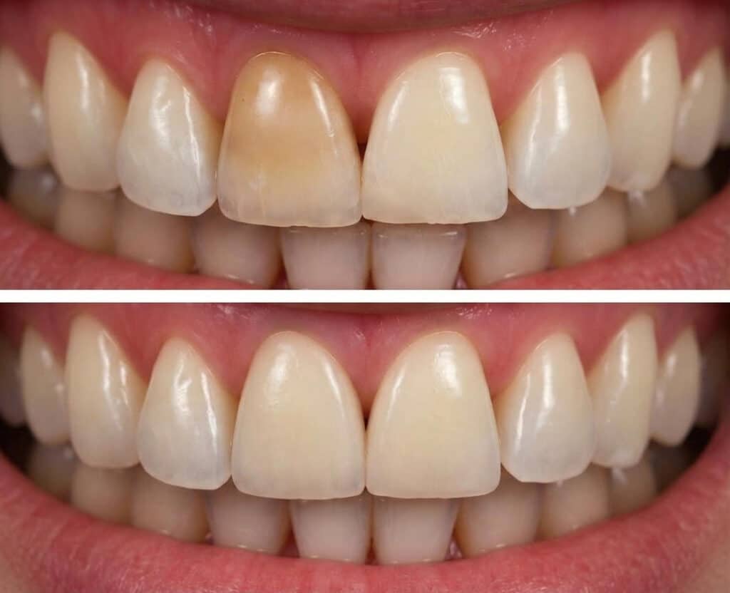 Veneers Zahnvergleich vorher-nachher